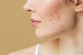 how to get rid of red spots on skin