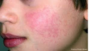 It can be caused by bacteria, viruses, or fungi, but bacterial meningitis is the rash is a bright scarlet and appears first on the face, neck, and torso; Children Rashes And Spots With Pictures Madeformums