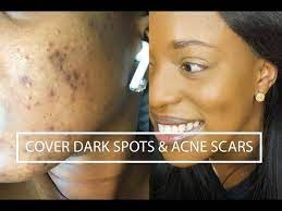 cover dark spots acne scars