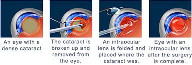 cataract surgery eugene cataract