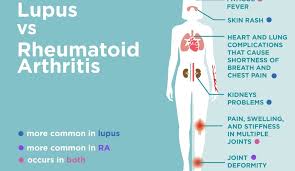 Lupus Vs Rheumatoid Arthritis Whats The Difference