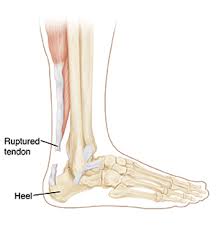 Muscles, tendons, and ligaments run along the surfaces of the feet, allowing the complex movements needed for motion and balance. Achilles Tendon Rupture