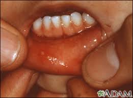 hand foot mouth disease information