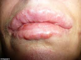 dermal filler lumps after lip
