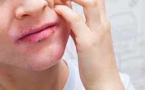 lip cancer signs and symptoms