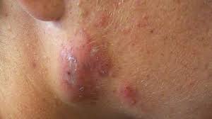 cystic acne identification causes