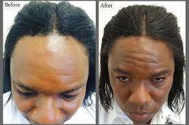 Be them social or professional, though, we all agree that results matter. Solutions For Men S Hair Loss Hair Restoration In Florida