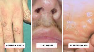 types of warts and how to treat them