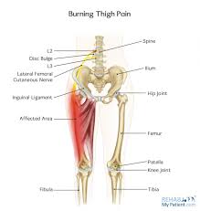 burning thigh pain rehab my patient