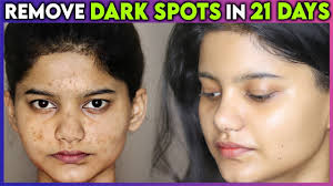 how to remove 100 dark spots naturally