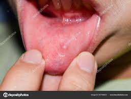 small vesicle lesion lower lip asian