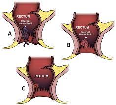 Internal hemorrhoids are found inside the rectum. Hemorrhoids Ascrs
