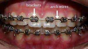 When you get your braces off, your braces have moved your teeth in to a position where they are not naturally accustomed. 4 Proven Ways To Straighten Crooked Or Misaligned Teeth