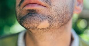 A stressful lifestyle can be devastating for your beard, and the rest of your body hopefully this guide on how to grow facial hair have helped you and you are on your way to epic beardness. Bald Patch In Beard Causes And Treatments
