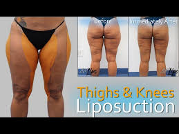 knee liposuction lipedema surgery