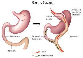 gastric byp surgery st louis mo