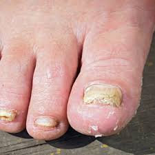 Have you noticed a black spot under your toe nail that shouldn't be there? Fungal Nail Infections Health Navigator Nz