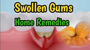 swollen gums home remes tips to