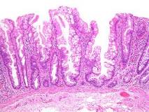 Image result for icd 10 code for sessile serrated adenoma of ascending colon