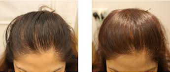 hair loss prp nyc