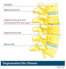 degenerative disc disease treatment san
