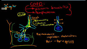 ED COPD Case Study   yr female