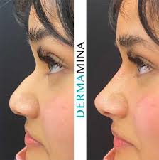 how non surigcal rhinoplasty can make