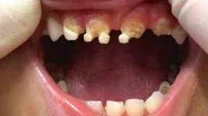 child s teeth destro and here s the