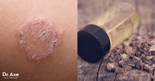 ringworm treatment try these 6 natural