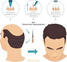 For tangled and matted wigs or weaves, this is an important thing. Hair Transplant Cost In India Current Price Details Ibh