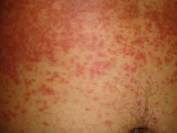 Fifth disease causes a distinctive red rash on the face that makes a child appear to have a slapped in older kids and adults, fifth disease can cause joint swelling and pain that can last from weeks to. Fever And Rash Infectious Disease Advisor