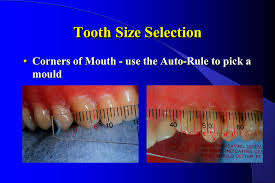 Selecting Denture Teeth Ppt Video Online Download