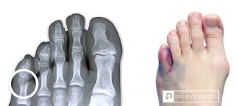 rotura del dedo meñique del pie