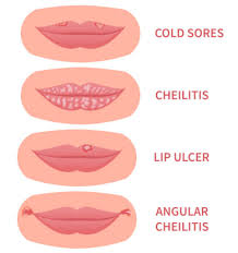 eczema on lips lip dermais triggers