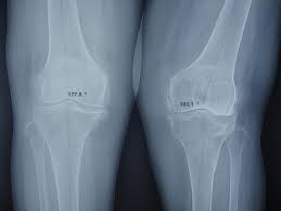 Nguy cơ bị tràn dịch trong ổ khớp do đôi chân thường