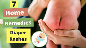 home remes for baby diaper rashes