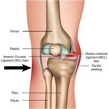 The ligament has sustained mild damage and been slightly stretched but can still keep the knee joint stable. Complex Ligament Injuries Mcl Pcl Surgeons Consultants Yorkshire