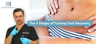 the 5 ses of tummy tuck recovery