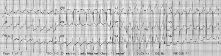 Jul 09, 2019 · psvt affects about 1 in every 2,500 children. Paroxysmal Supraventricular Tachycardia Diagnosis And Management
