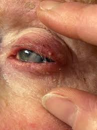 eye infections from tainted erops