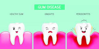 celebrate gum disease awareness month