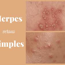 herpes and pimples