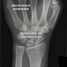 The first carpal is small, elongated from before backward, rounded and articulates in front with the second carpal. Emrad Radiologic Approach To The Traumatic Wrist