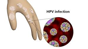 Human papillomavirus (hpv) is a group of viruses that are extremely common worldwide. Human Papillomavirus Hpv Infection Causes Symptoms And Treatment