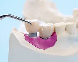 Dental implants improve oral health