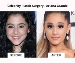 celebrity plastic surgery 51 before