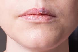 how to get rid of a pimple on your lip