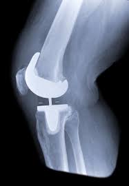 knee replacement knee arthroplasty