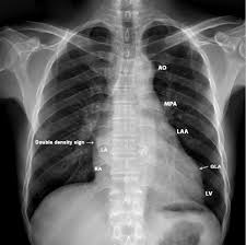 The heart heart is a very important organ which acts as a muscular pump. X Ray Chest Pa Postero Anterior View Showing The 4 Bump Left Heart Download Scientific Diagram