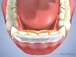 Hawley Spring Aligner- Naidu Orthodontics - YouTube | Orthodontics, Diy braces, Orthodontic appliances